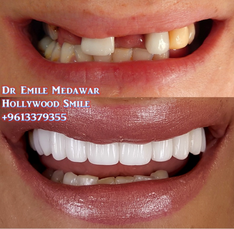 قبل وبعد فينيرز إيماكس